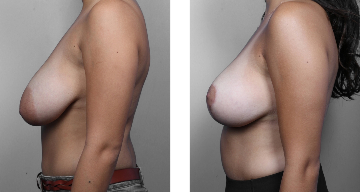 Breast Reduction before & after Patient 8