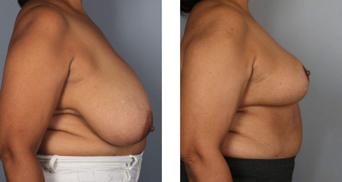 Breast Reduction before & after Patient 9
