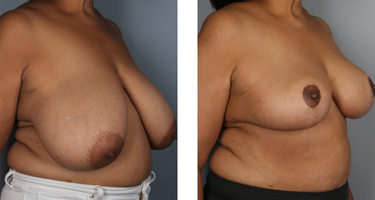 Breast Reduction before & after Patient 9