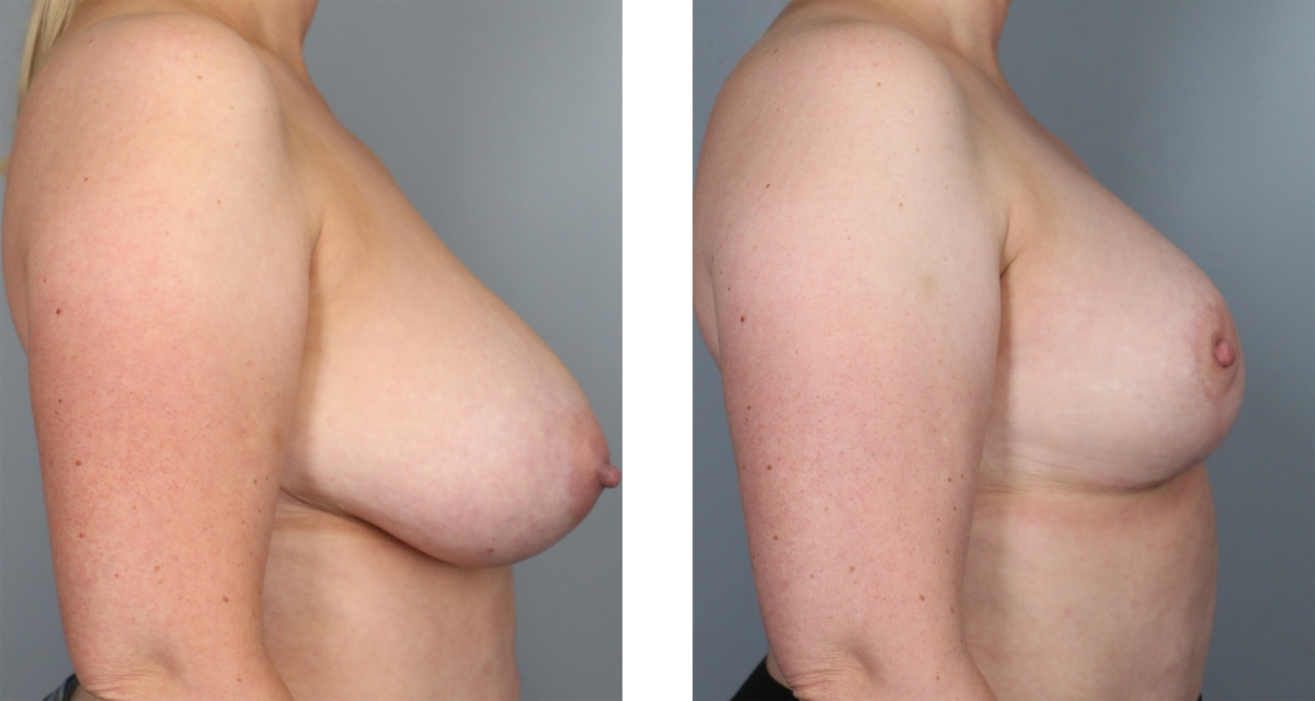 Breast Reduction before & after Patient 10