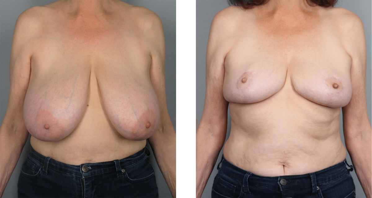 Breast Reduction before & after Patient 11