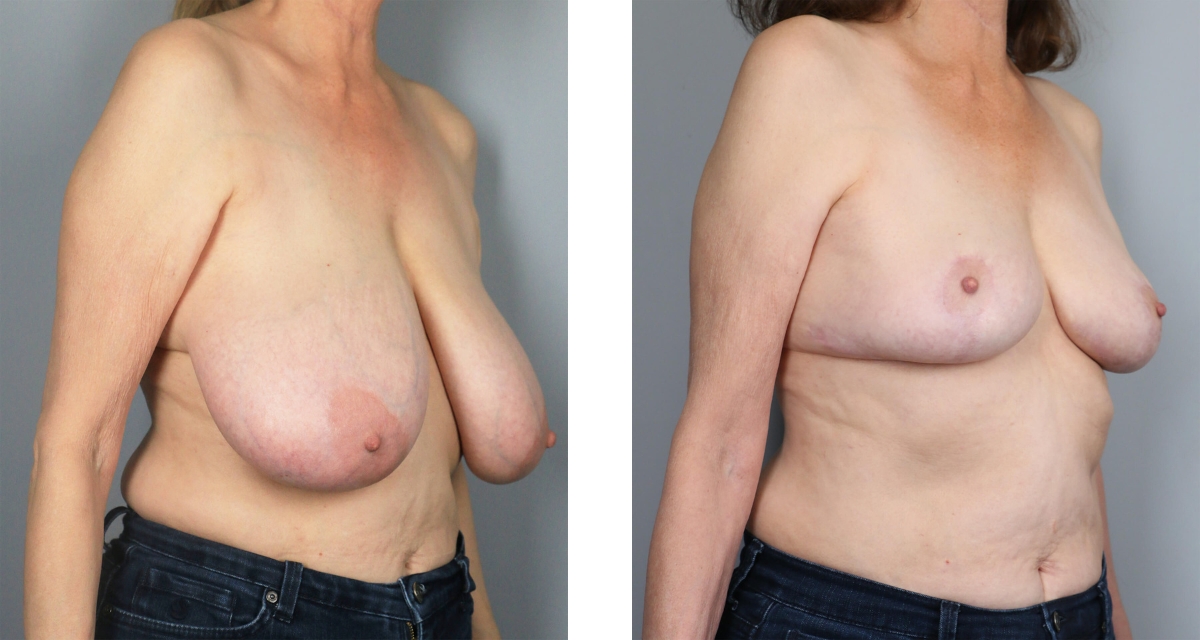 Breast Reduction before & after Patient 11