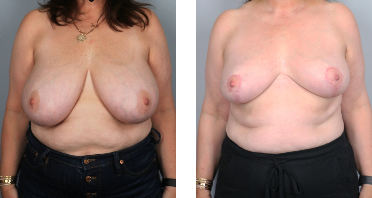 Breast Reduction before & after Patient 12