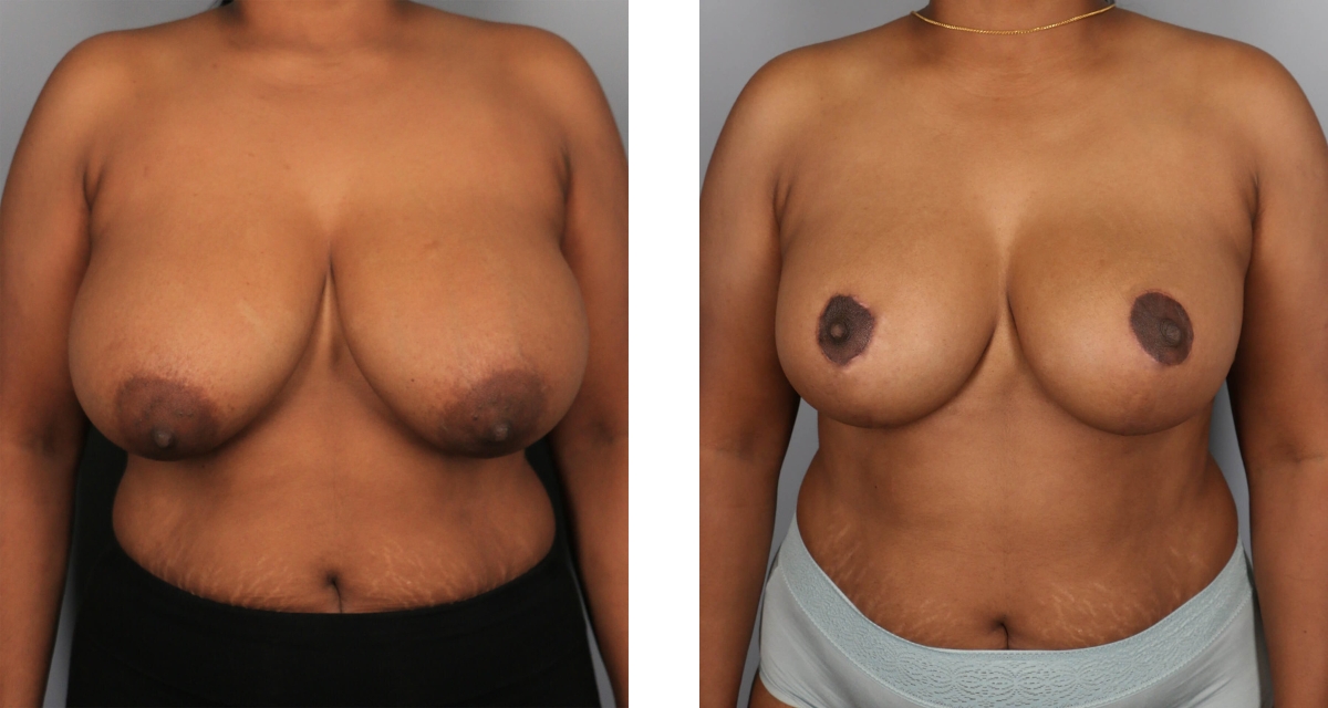 Breast Reduction before & after Patient 13