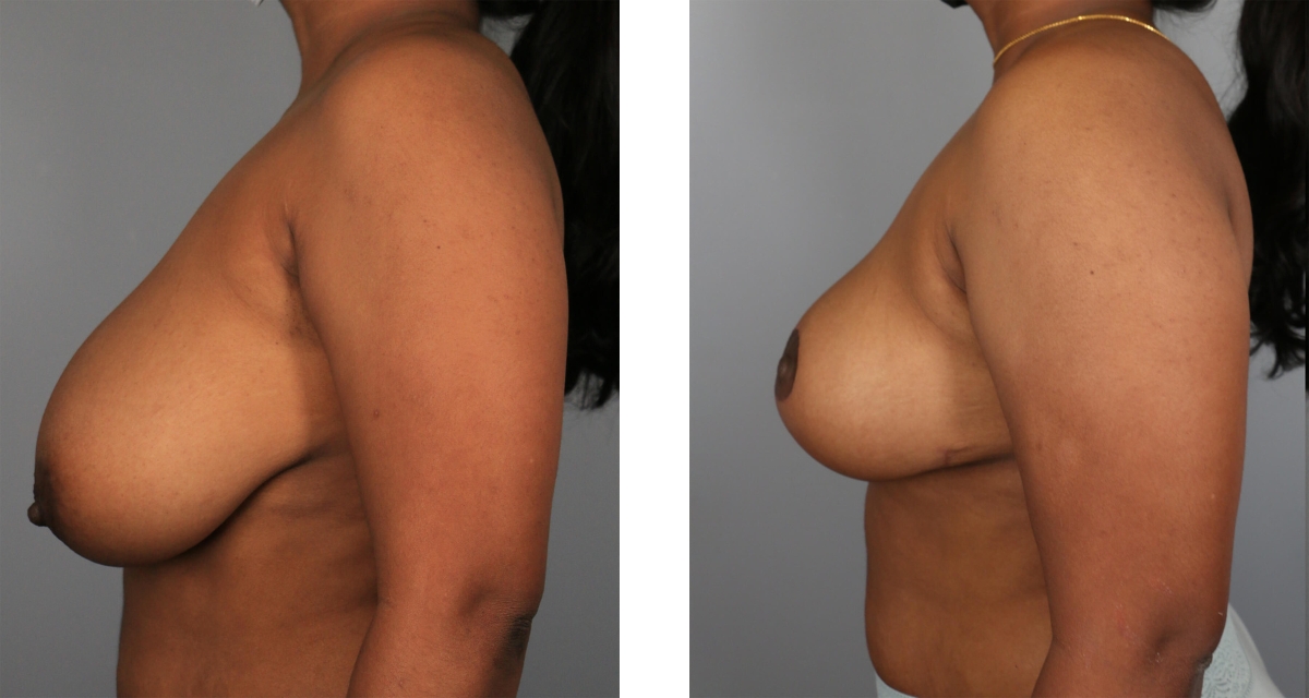 Breast Reduction before & after Patient 13