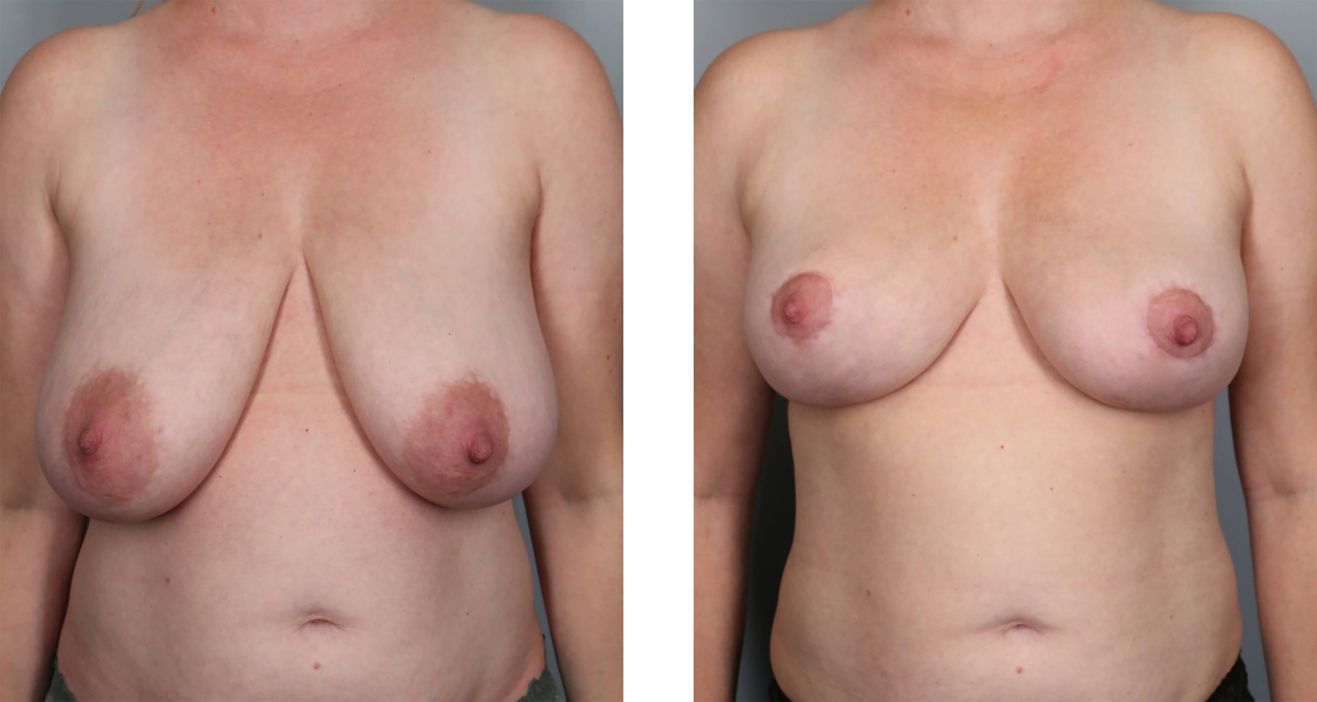 Breast Reduction before & after Patient 14