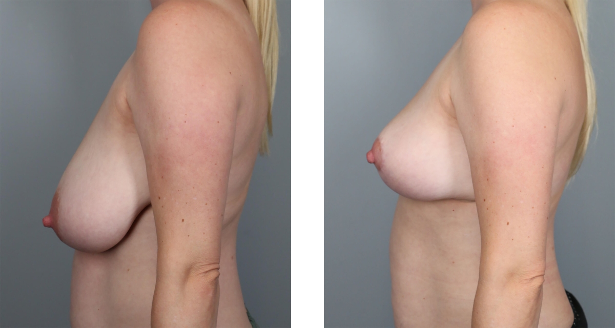 Breast Reduction before & after Patient 14