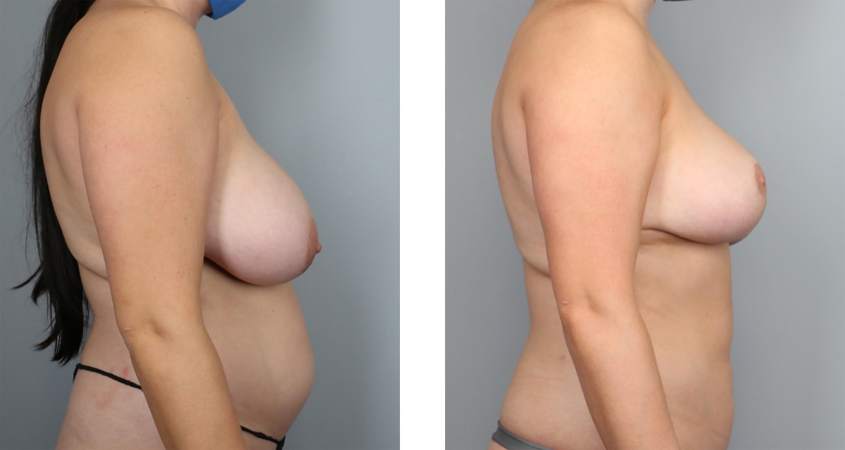 Breast Reduction before & after Patient 15