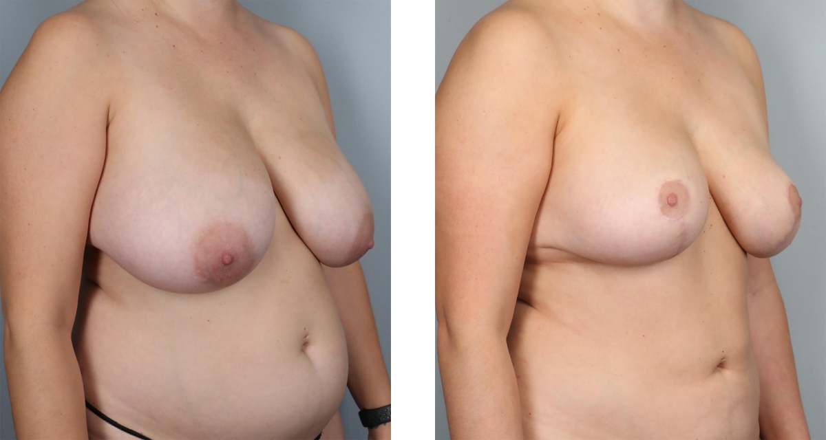 Breast Reduction before & after Patient 15