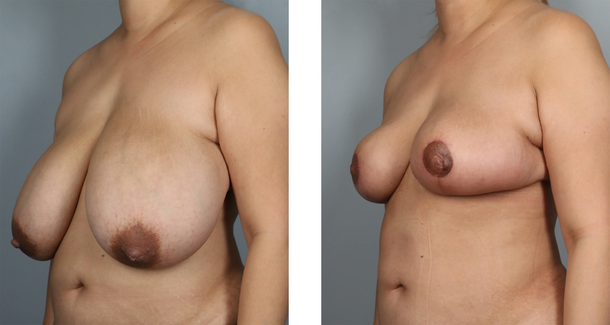 Breast Reduction before & after Patient 16