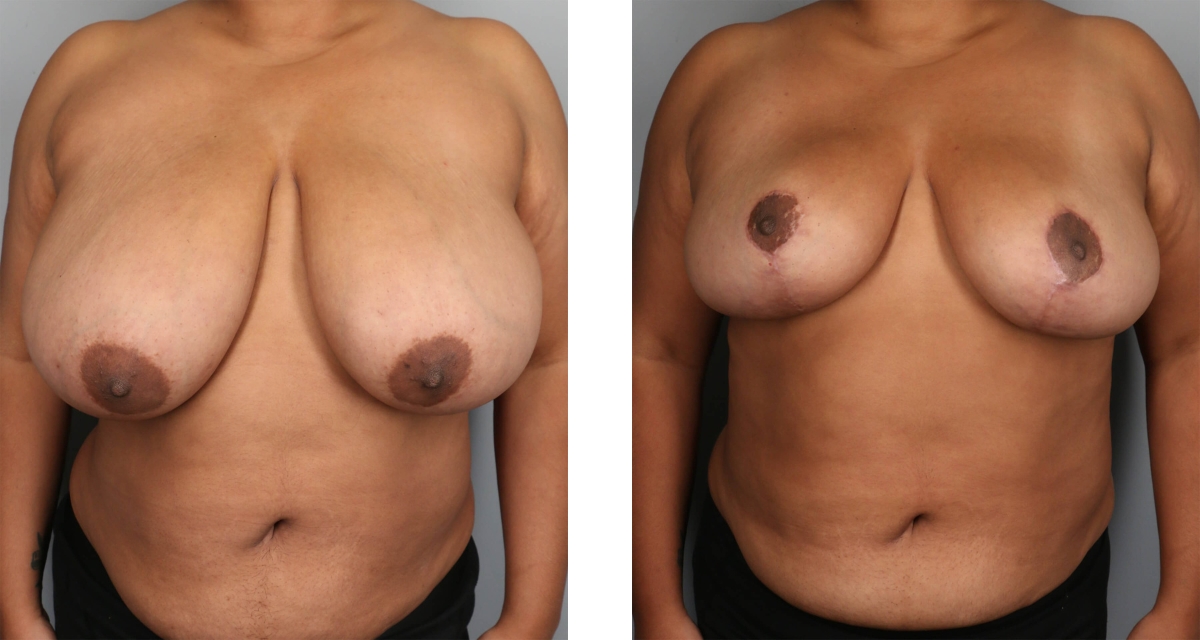Breast Reduction before & after Patient 17