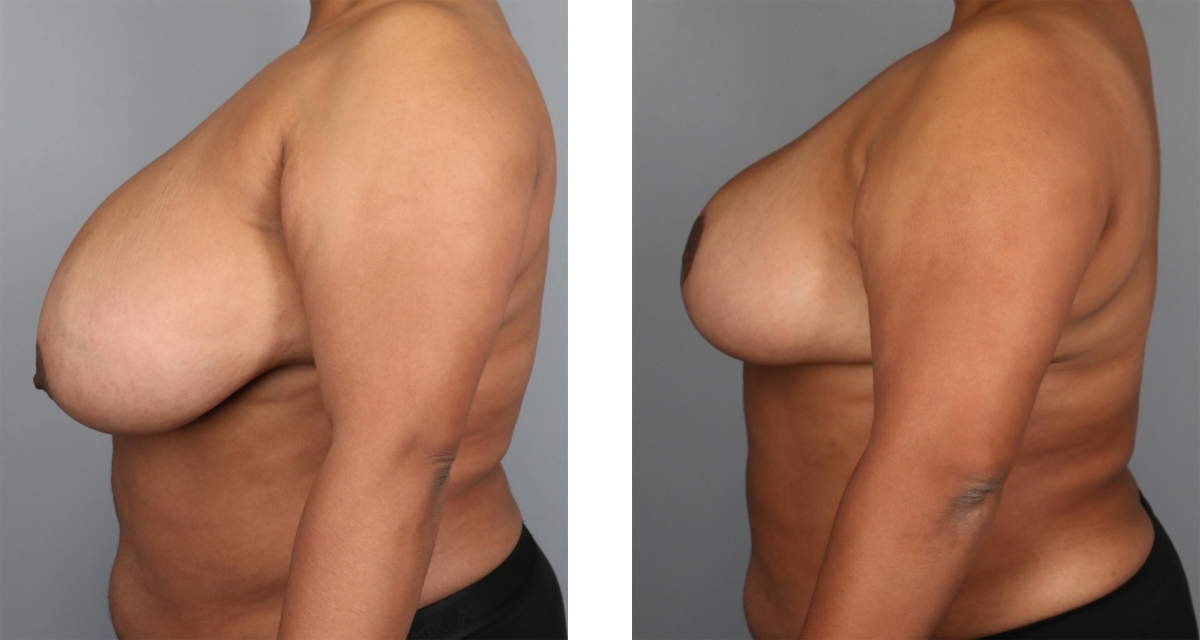 Breast Reduction before & after Patient 17