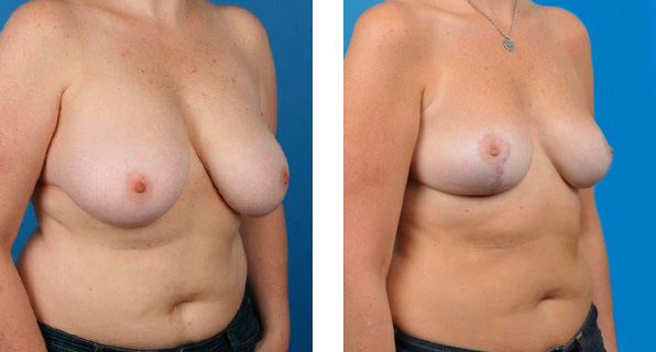 Breast Reduction before & after Patient 2