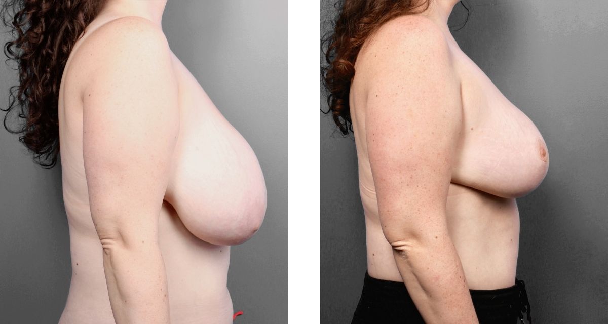 Breast Reduction before & after Patient 19