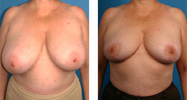 Breast Reduction before & after Patient 4