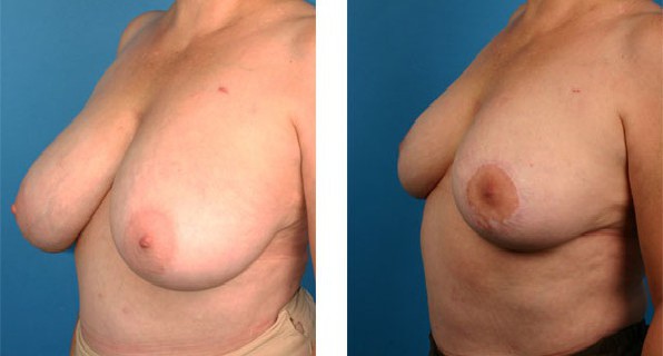 Breast Reduction before & after Patient 4