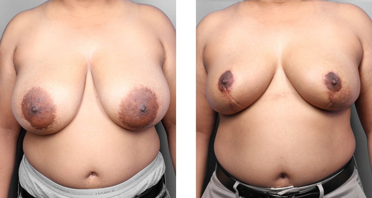 Breast Reduction before & after Patient 22