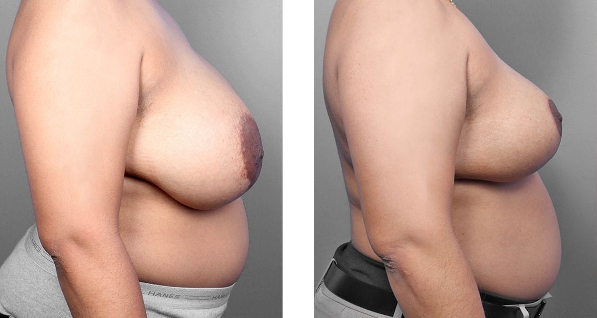 Breast Reduction before & after Patient 22