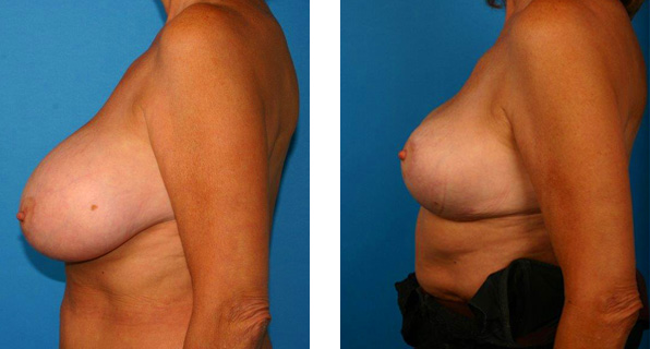 Breast Reduction before & after Patient 5