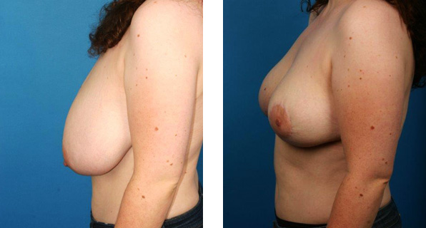 Breast Reduction before & after Patient 6