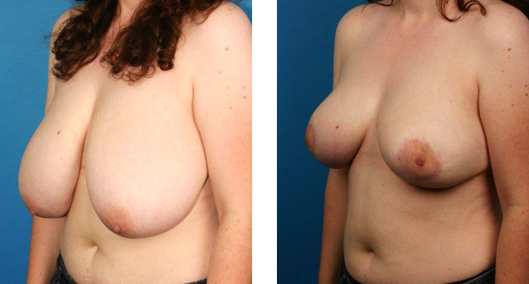 Breast Reduction before & after Patient 6