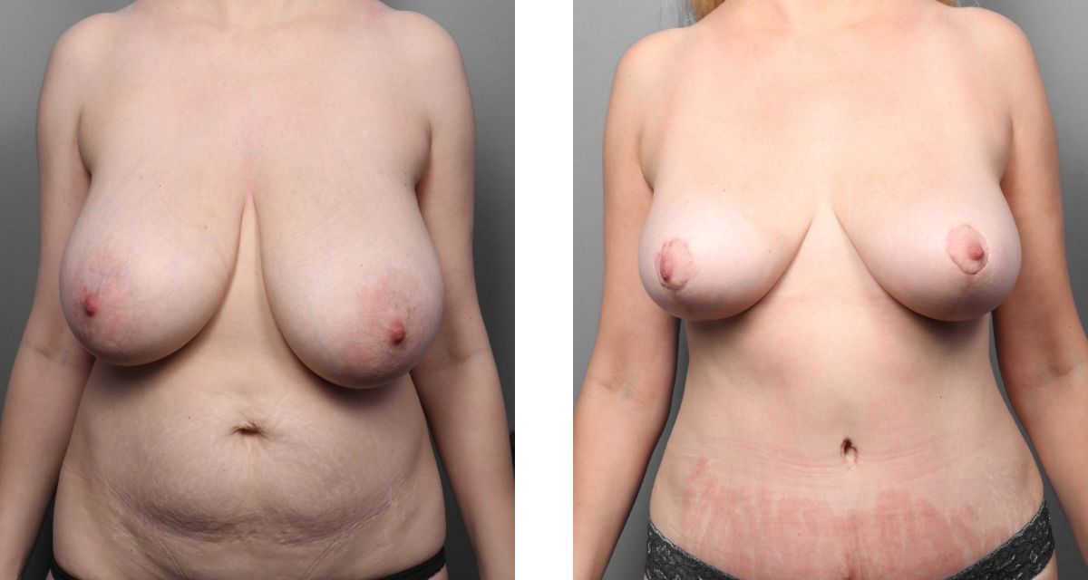 Breast Reduction before & after Patient 23