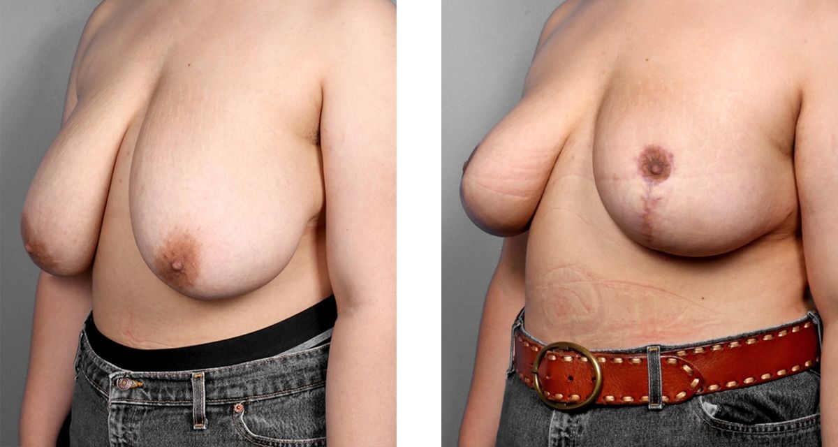Breast Reduction before & after Patient 24