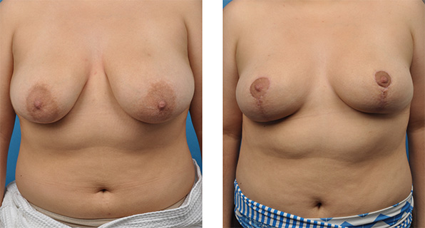 Breast Reduction before & after Patient 7