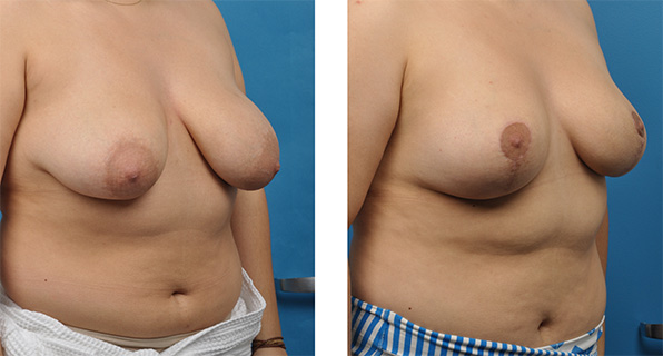 Breast Reduction before & after Patient 7
