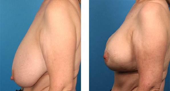 Breast Reduction before & after Patient 8
