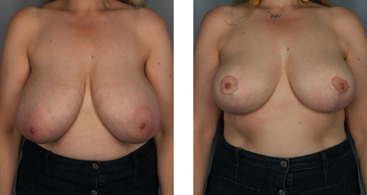 Breast Reduction before & after Patient 25