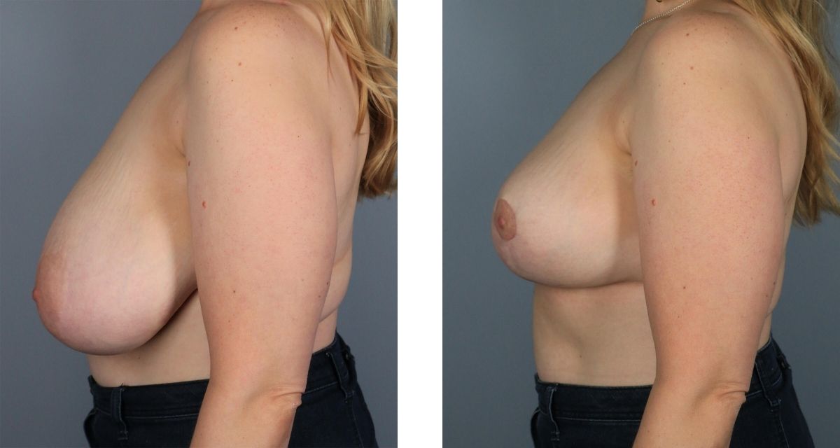 Breast Reduction before & after Patient 25