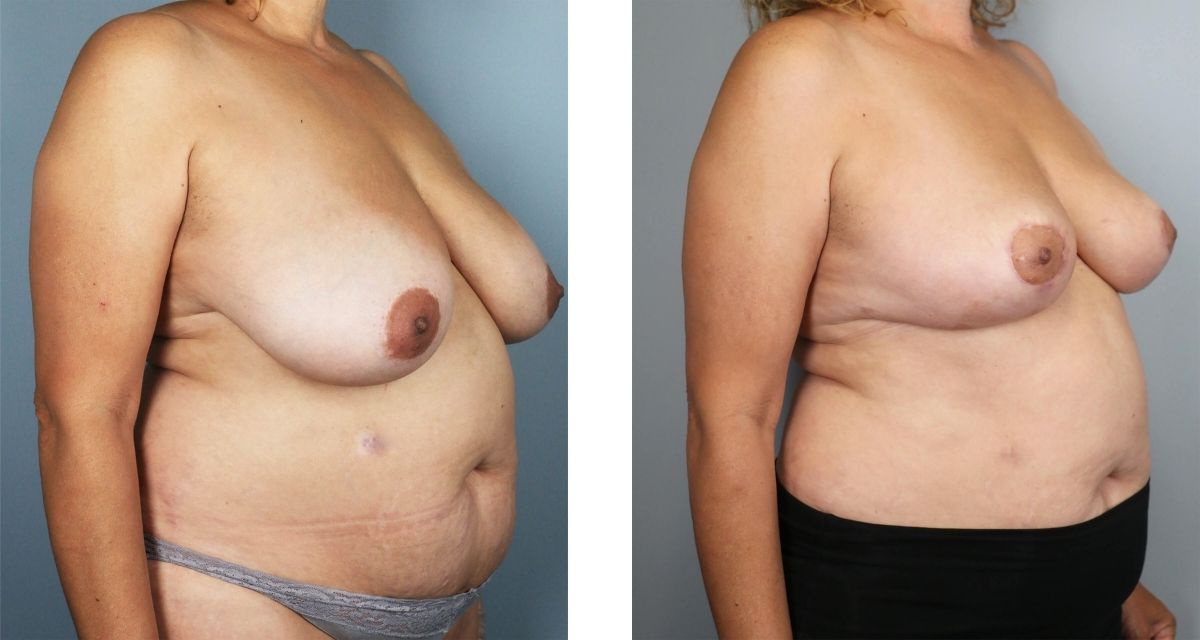 Breast Reduction before & after Patient 26