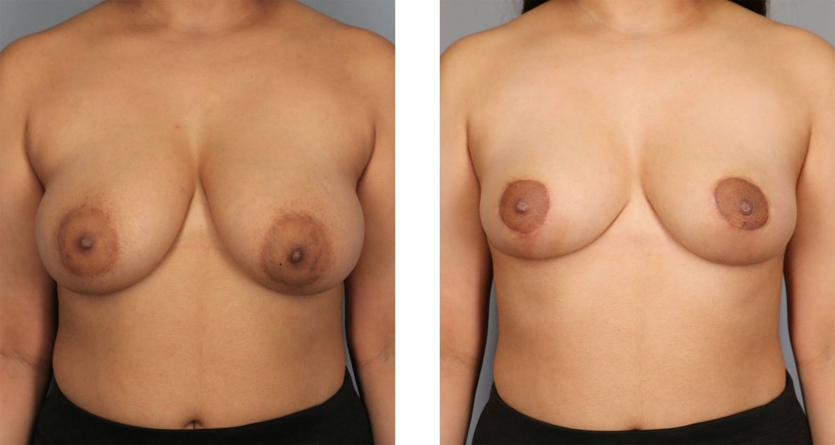 Breast Reduction before & after Patient 20