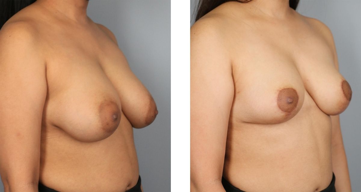Breast Reduction before & after Patient 20