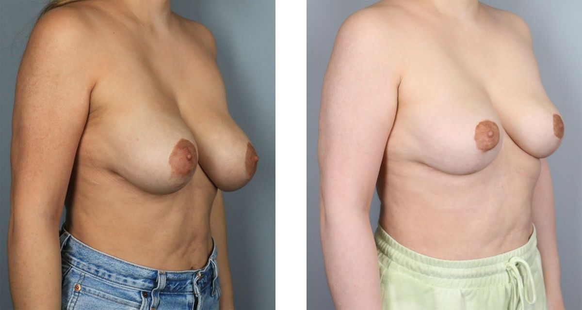 Breast Reduction before & after Patient 28