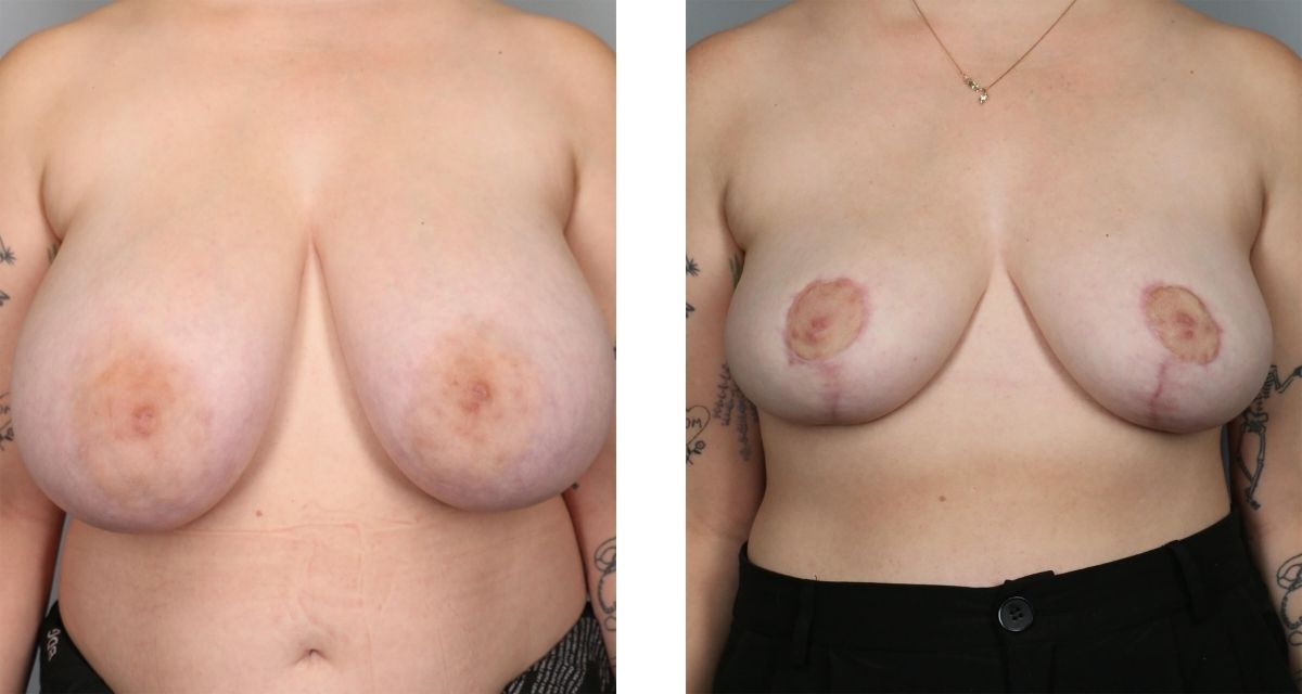 Breast Reduction before & after Patient 29