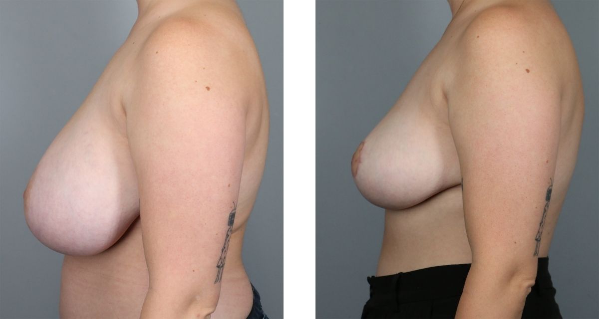 Breast Reduction before & after Patient 29