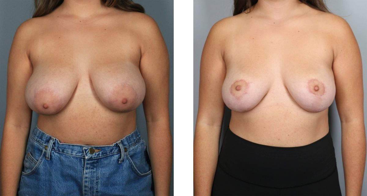 Breast Reduction before & after Patient 30