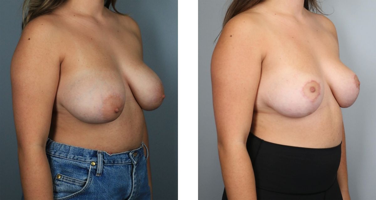 Breast Reduction before & after Patient 30