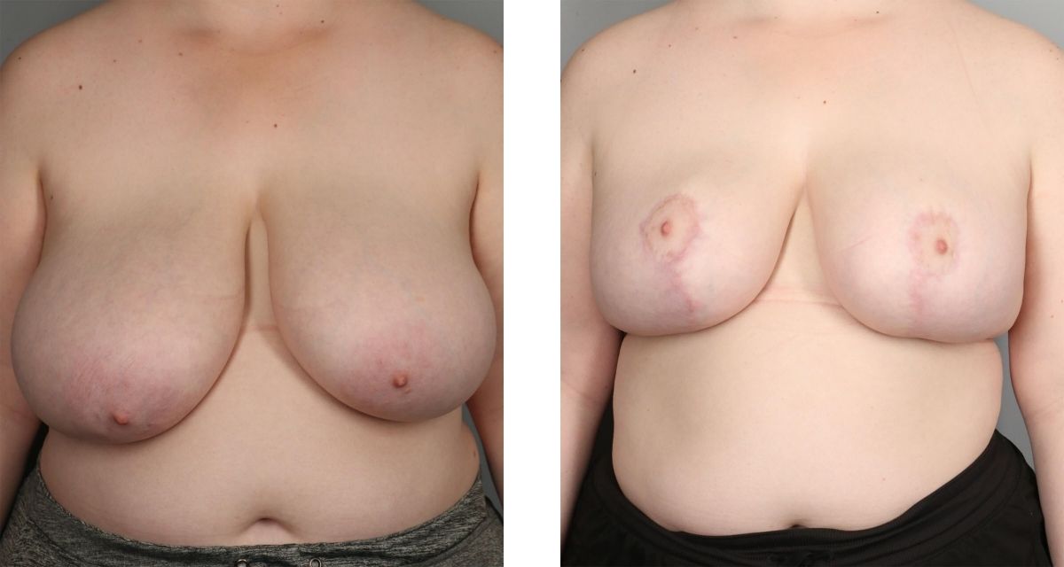 Breast Reduction before & after Patient 31