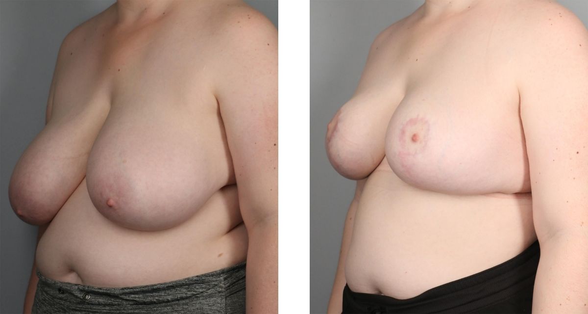 Breast Reduction before & after Patient 31