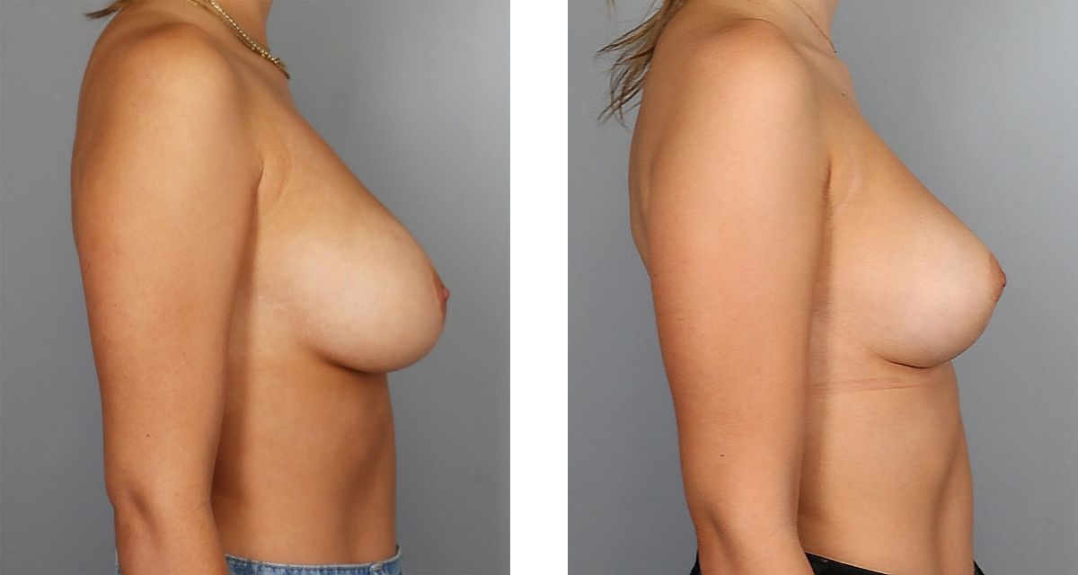 Breast Reduction before & after Patient 21