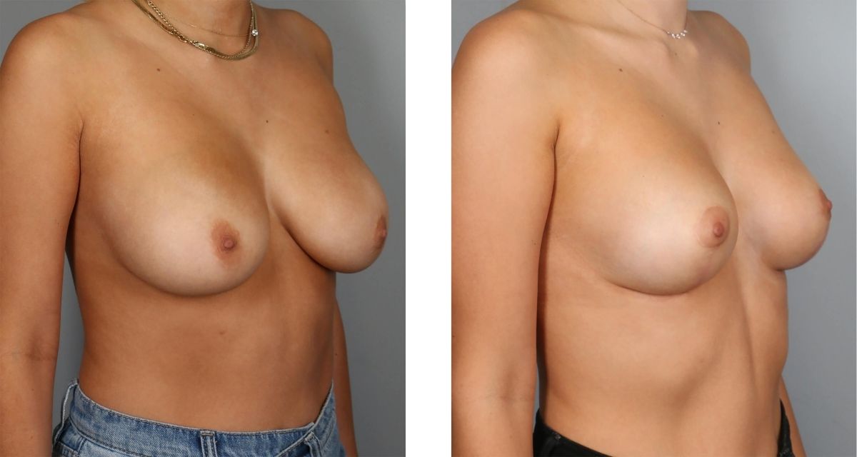 Breast Reduction before & after Patient 21