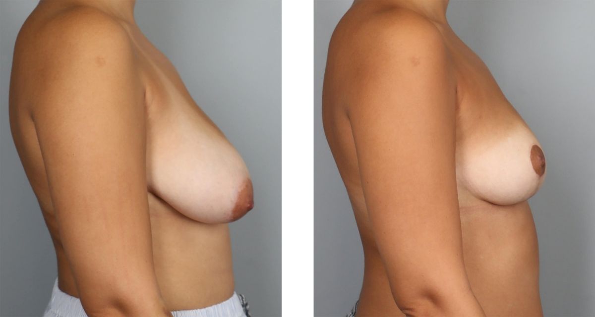 Breast Reduction before & after Patient 33