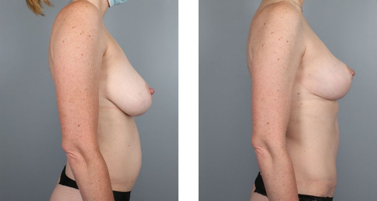 Breast Reduction before & after Patient 34