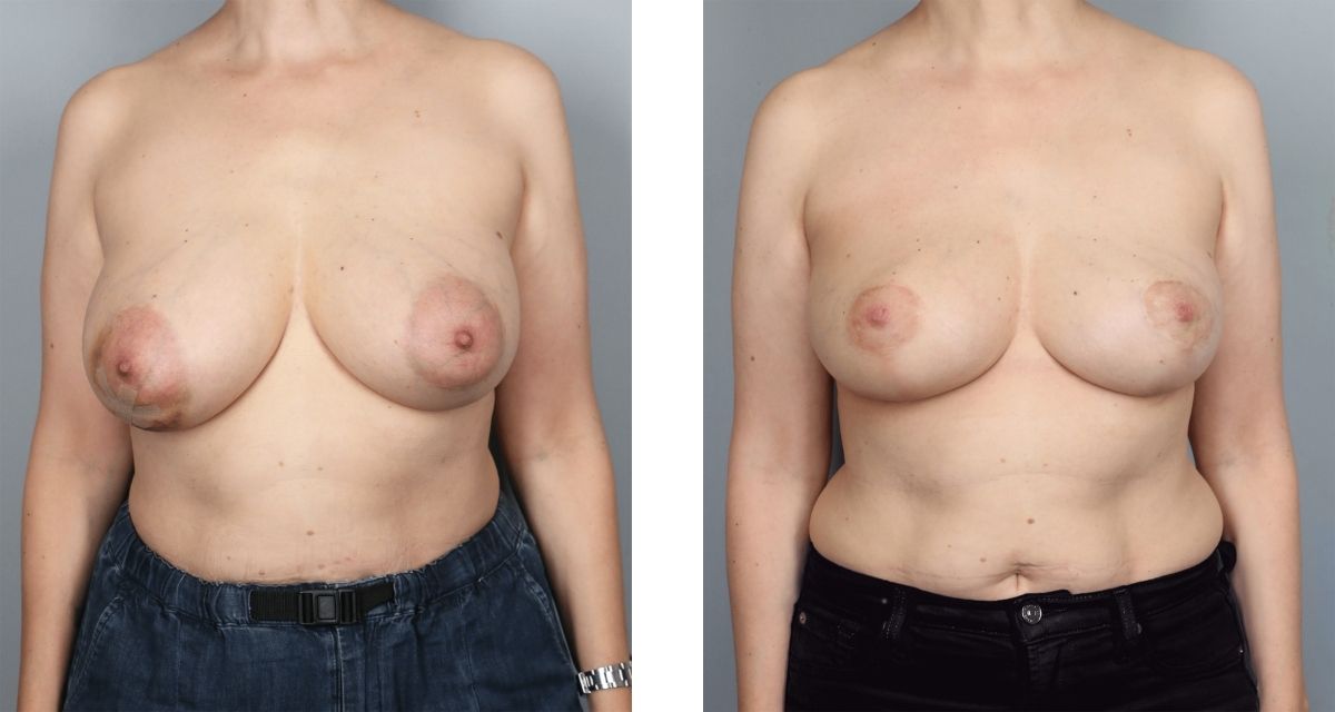 Breast Reduction before & after Patient 35