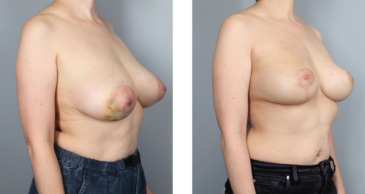Breast Reduction before & after Patient 35