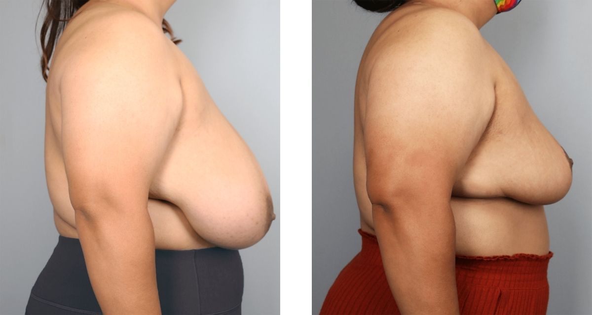 Breast Reduction before & after Patient 36
