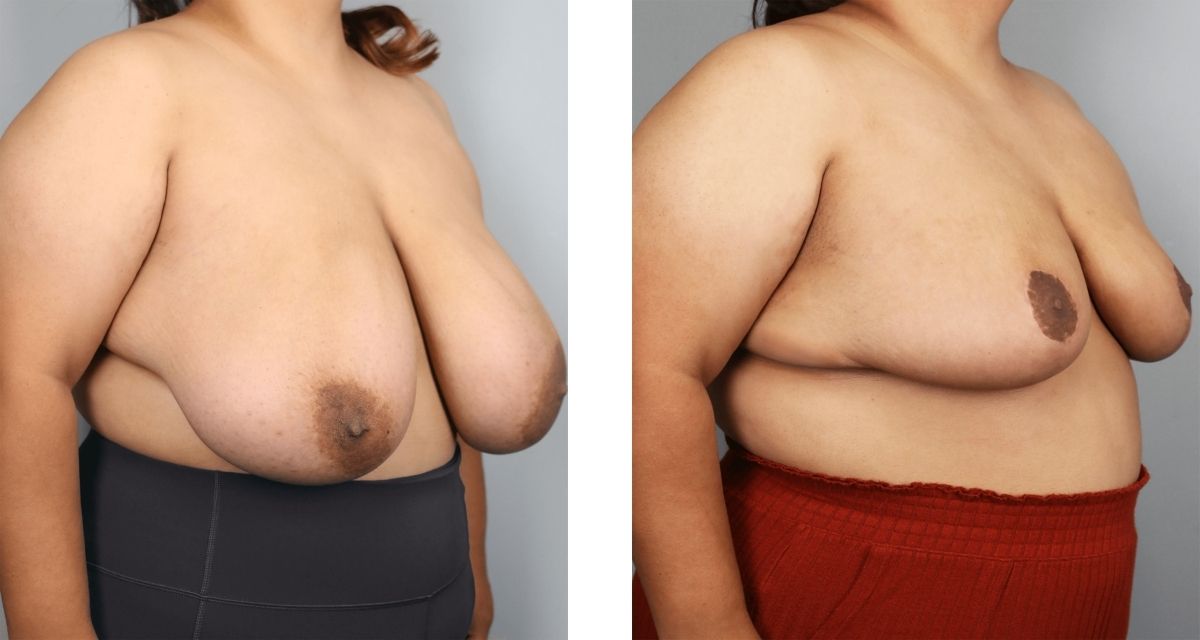 Breast Reduction before & after Patient 36